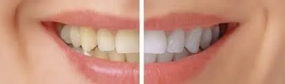 34199 teeth whitening mesa az take home kit