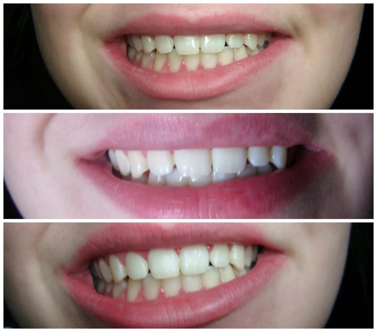 34203 dollar tree whitening gel