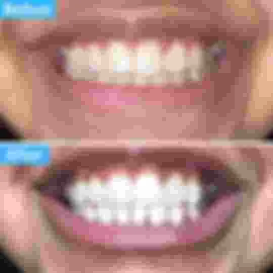 34223 teeth whitening results