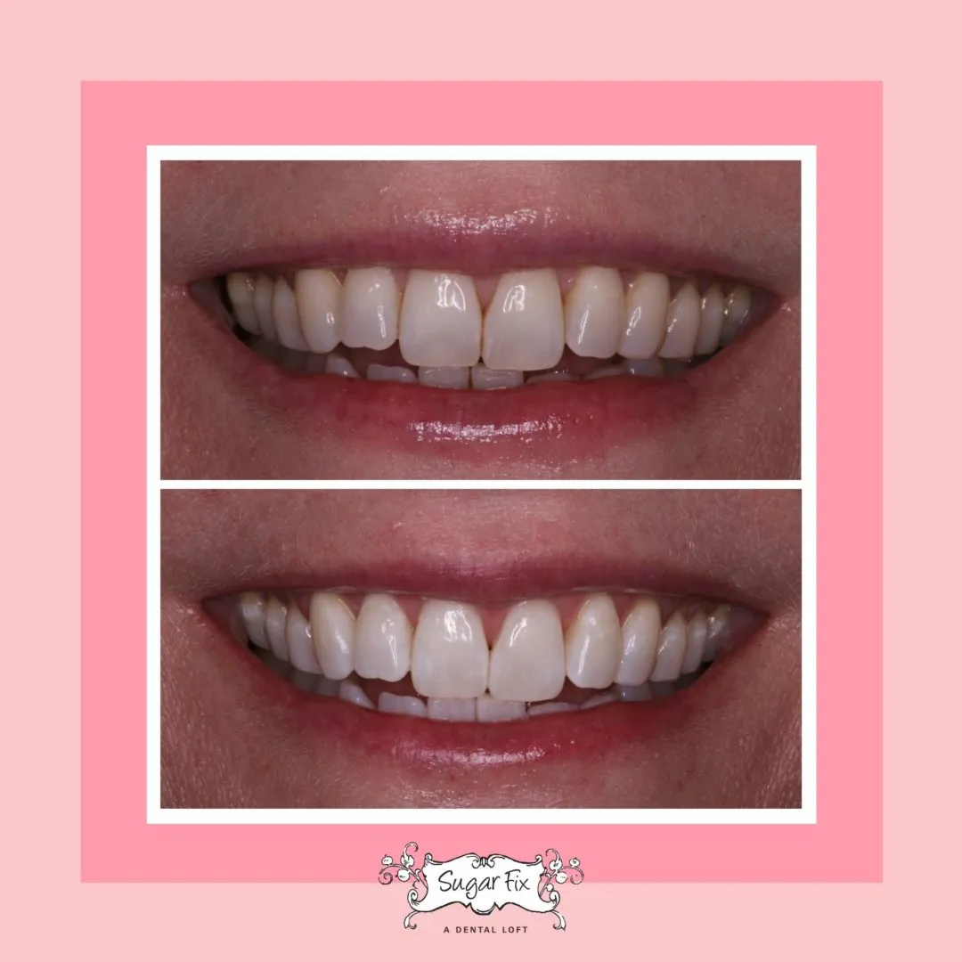 34233 teeth sensitivity