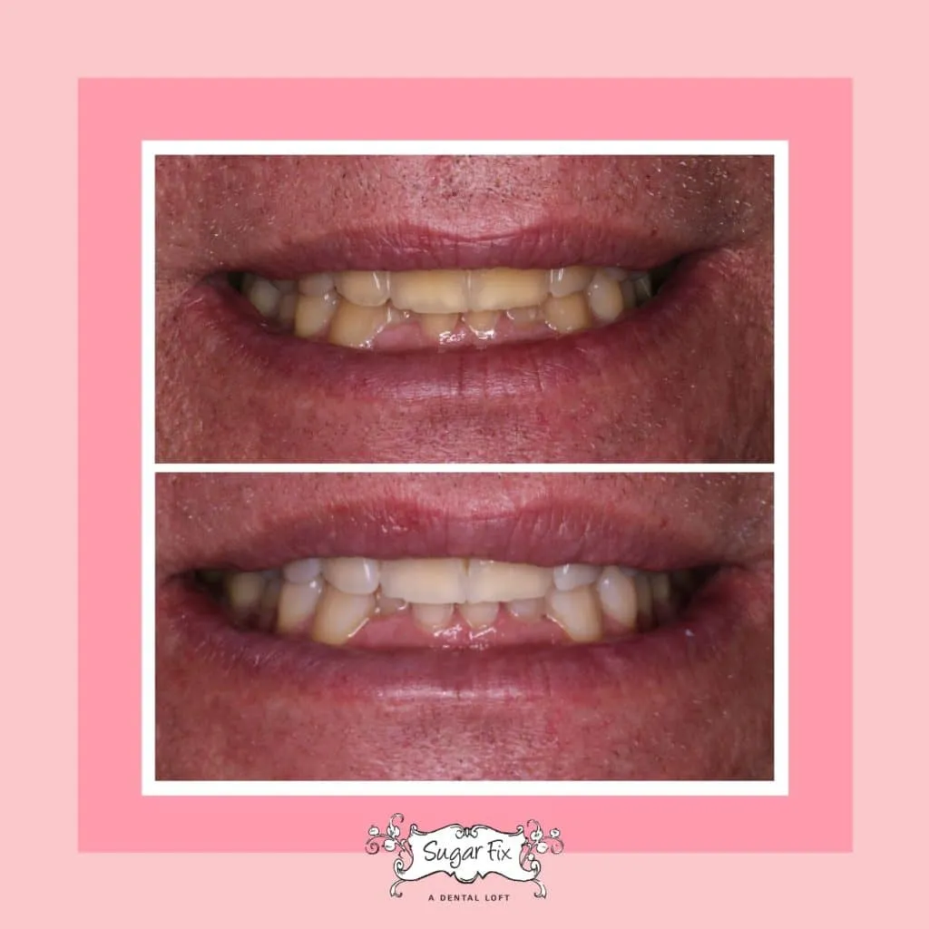 /img/34233-teeth-whitening-results.webp