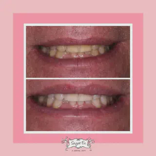 /img/34233-teeth-whitening-results.webp