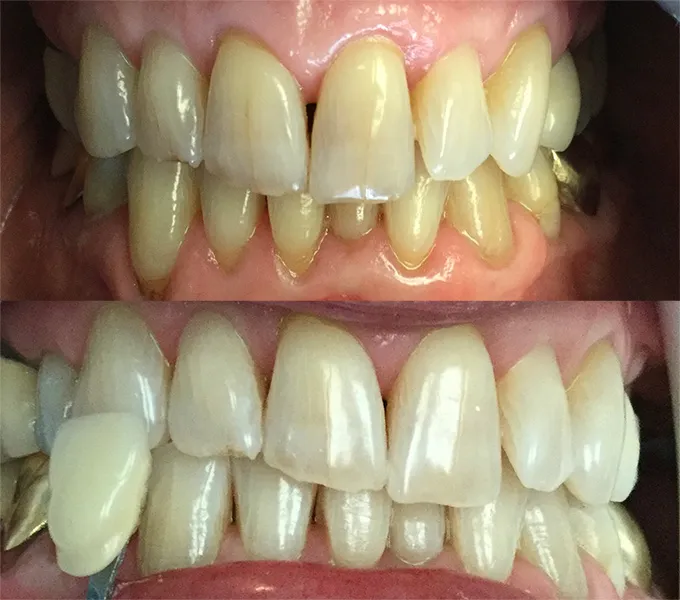 34270 geha dental at home whitening kit