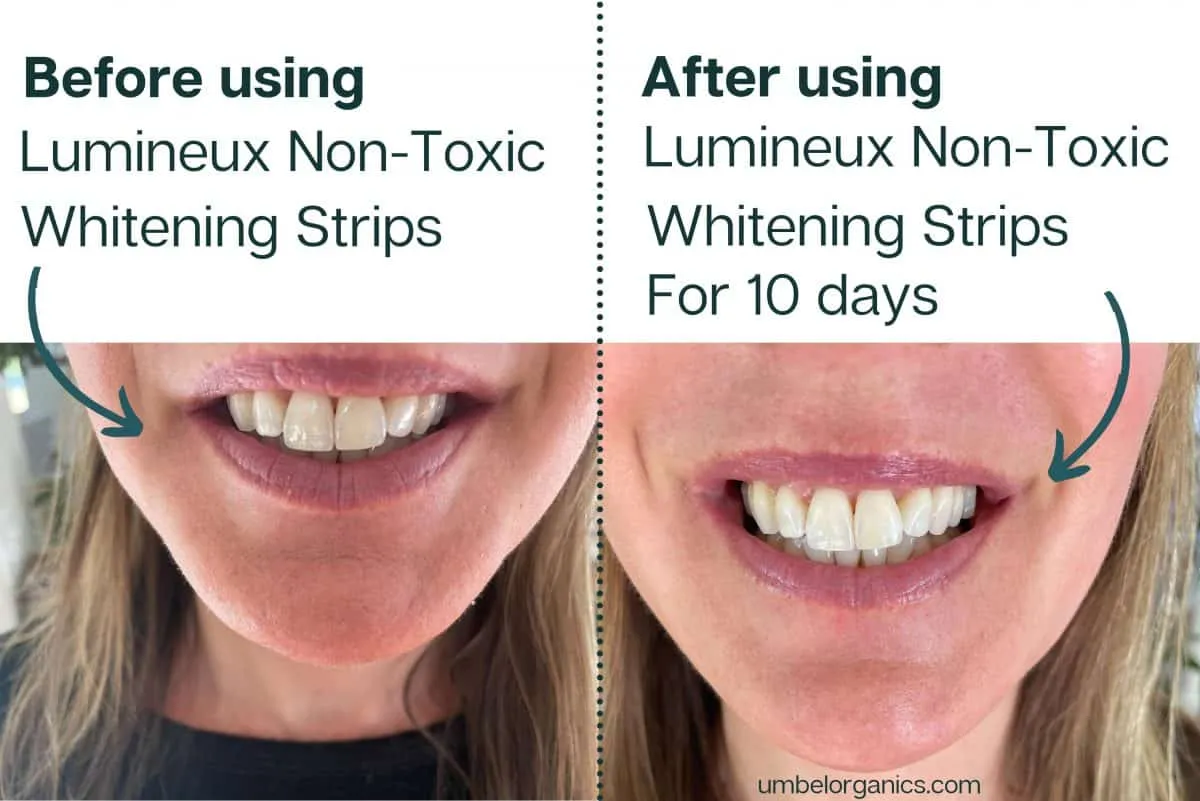 34271 professional whitening