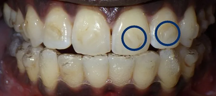 34273 take home whitening trays