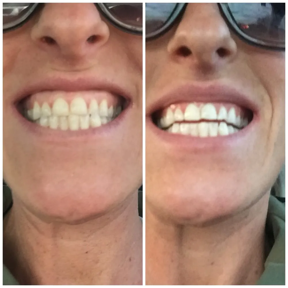 34278 foods to avoid teeth whitening