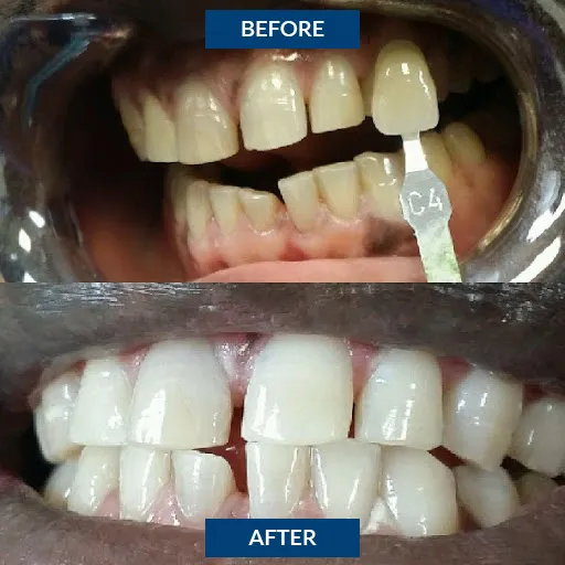 34281 teeth whitening application
