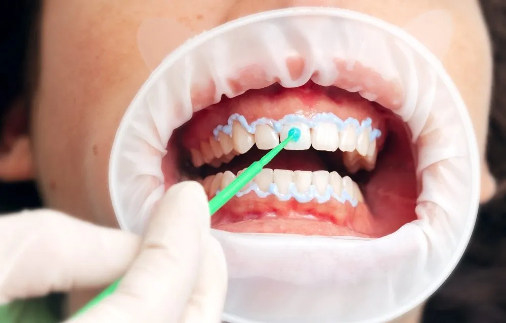 34289 sensitive teeth