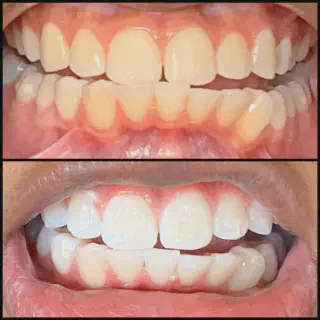 /img/34298-teeth-whitening-huntington-beach-maintenance.webp