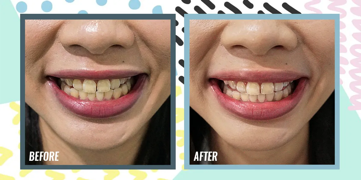 34307 iwhite teeth whitening singapore 1