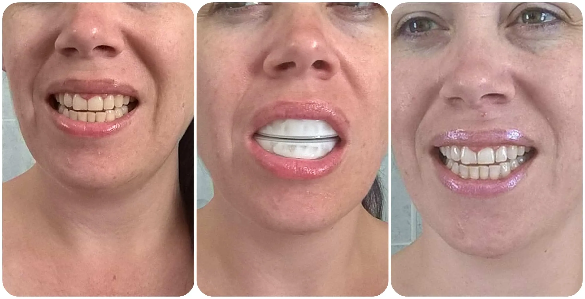 34307 iwhite teeth whitening singapore 5
