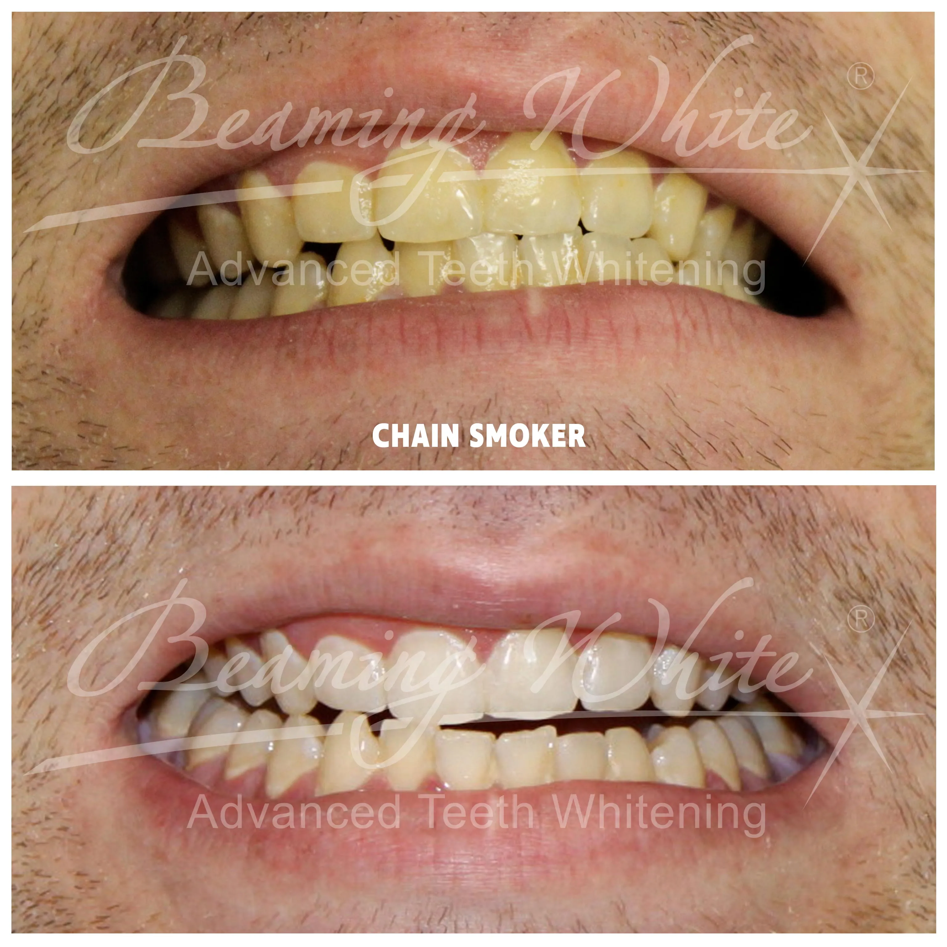 34310 smoking teeth