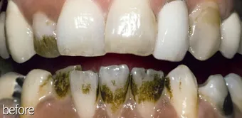 34310 teeth whitening