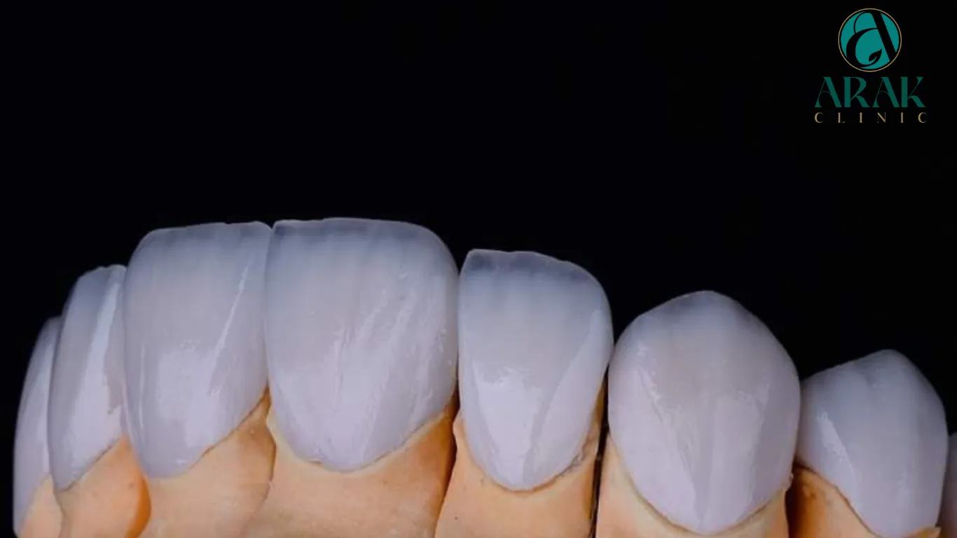 34315 zoom teeth whitening candidates