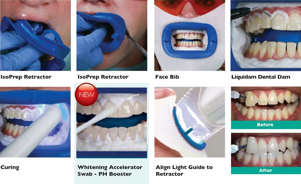/img/34315-zoom-teeth-whitening-cost.webp