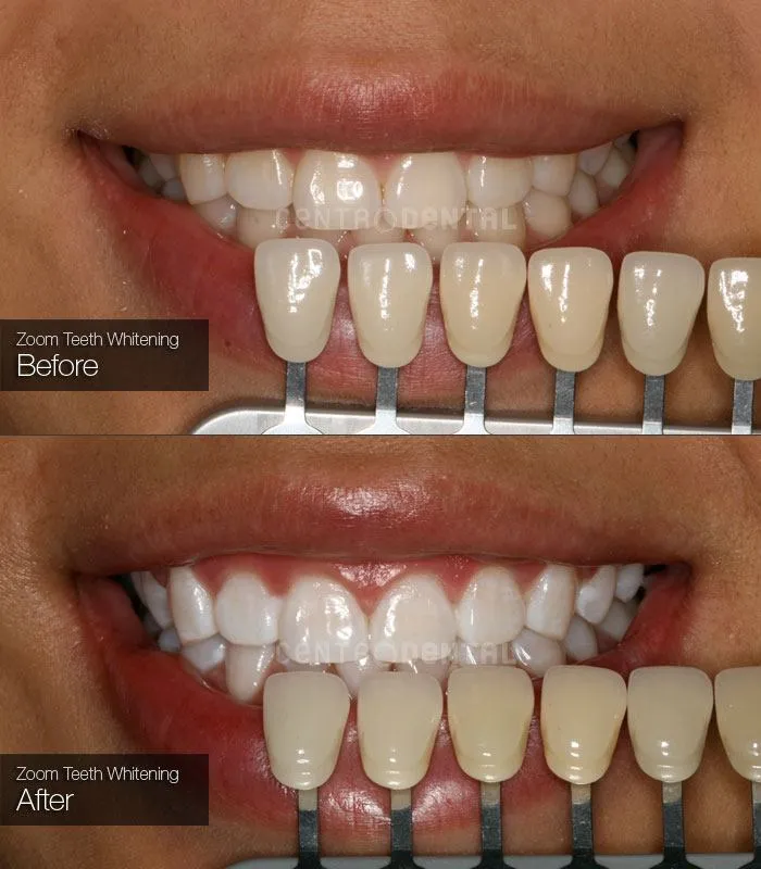 34315 zoom whitening before after