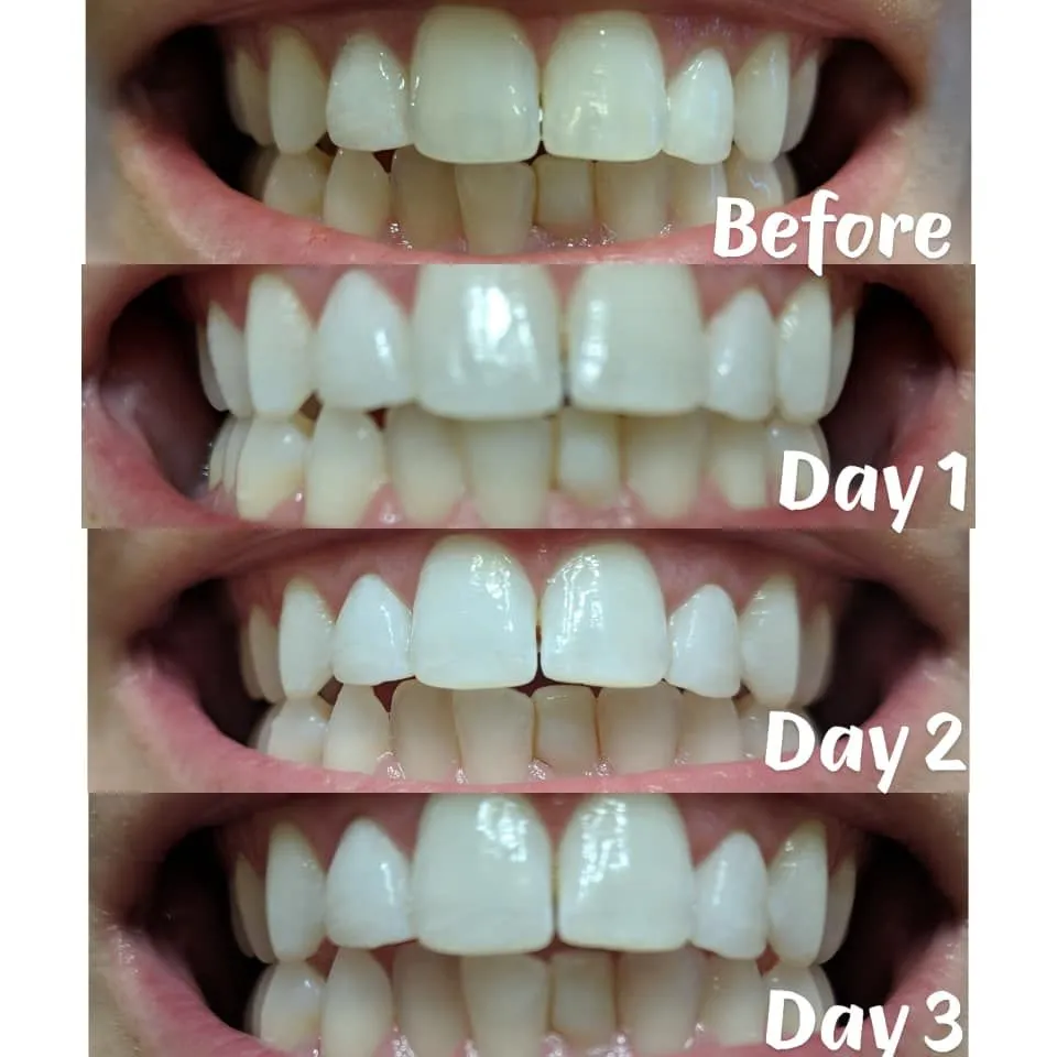 34323 teeth whitening results