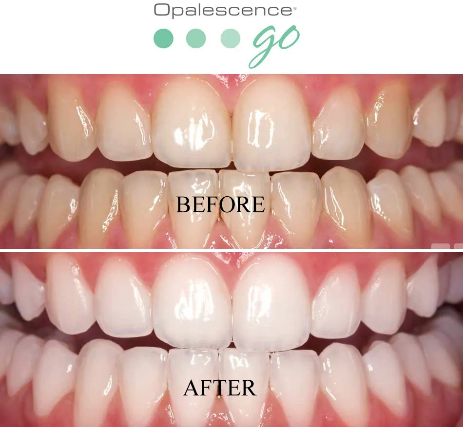 34329 teeth sensitivity