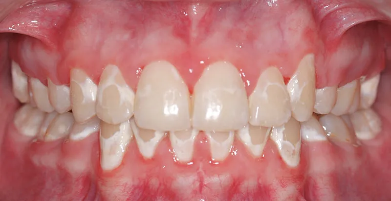 34344 fluorosis teeth 5