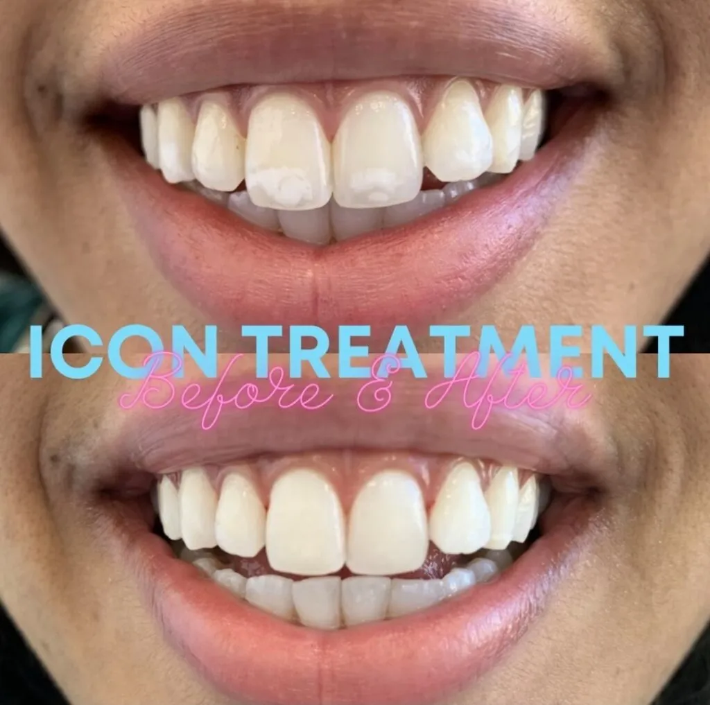 34344 teeth whitening prevention 7
