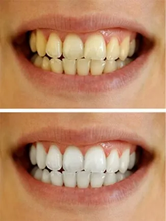 34371 dry mouth