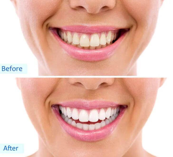 34376 smiling perfect teeth