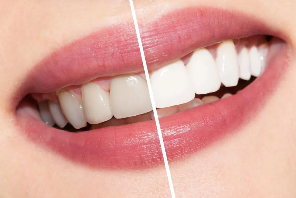 34377 teeth whitening dentist