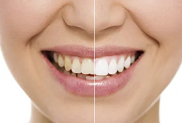 34377 teeth whitening food
