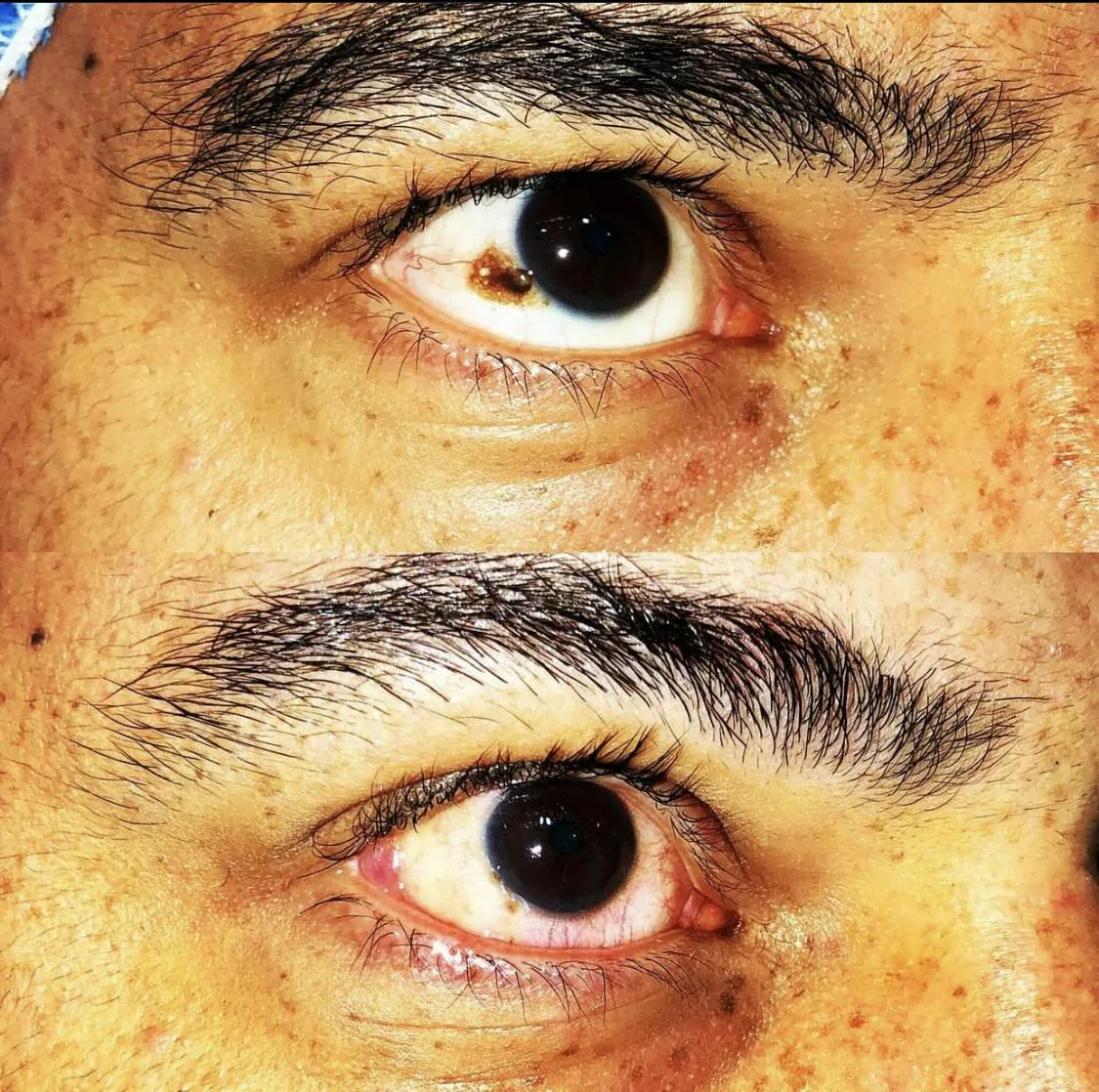 34393 chemical peel eye
