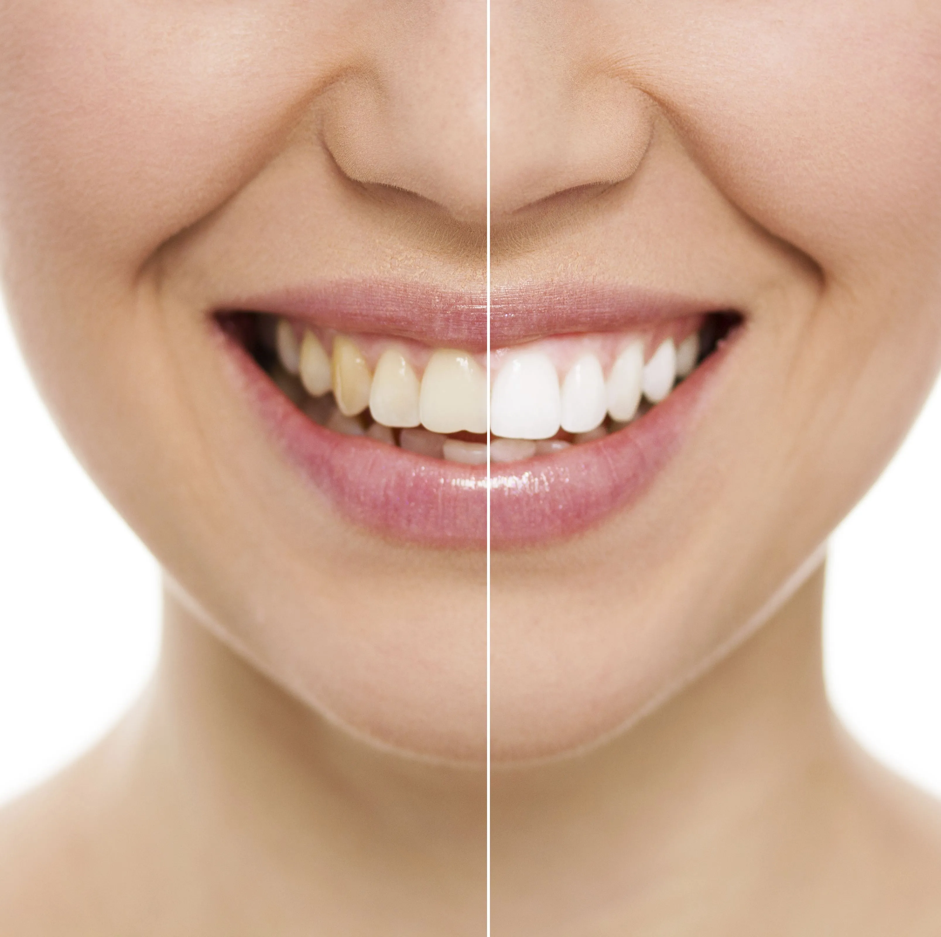 34426 professional teeth whitening