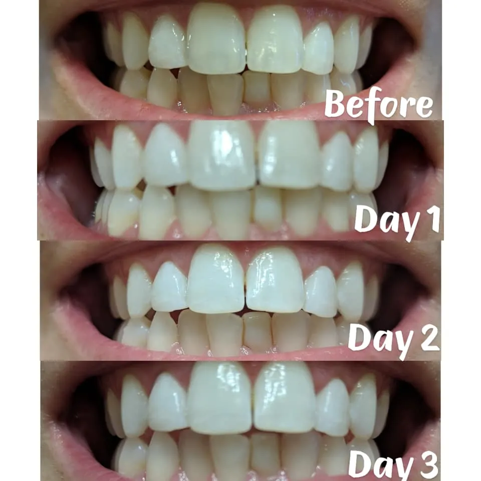 34426 teeth whitening alternatives