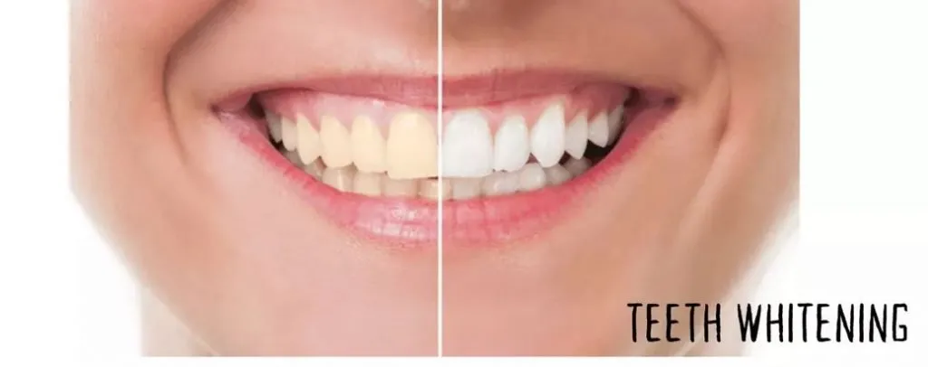 34438 teeth whitening monaghan at home