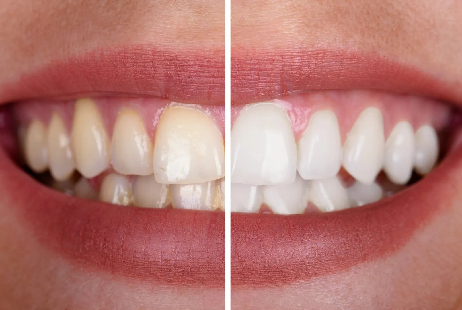 34438 teeth whitening monaghan in office