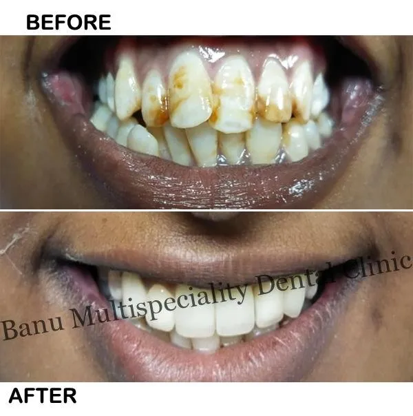 34438 teeth whitening monaghan whitening trays