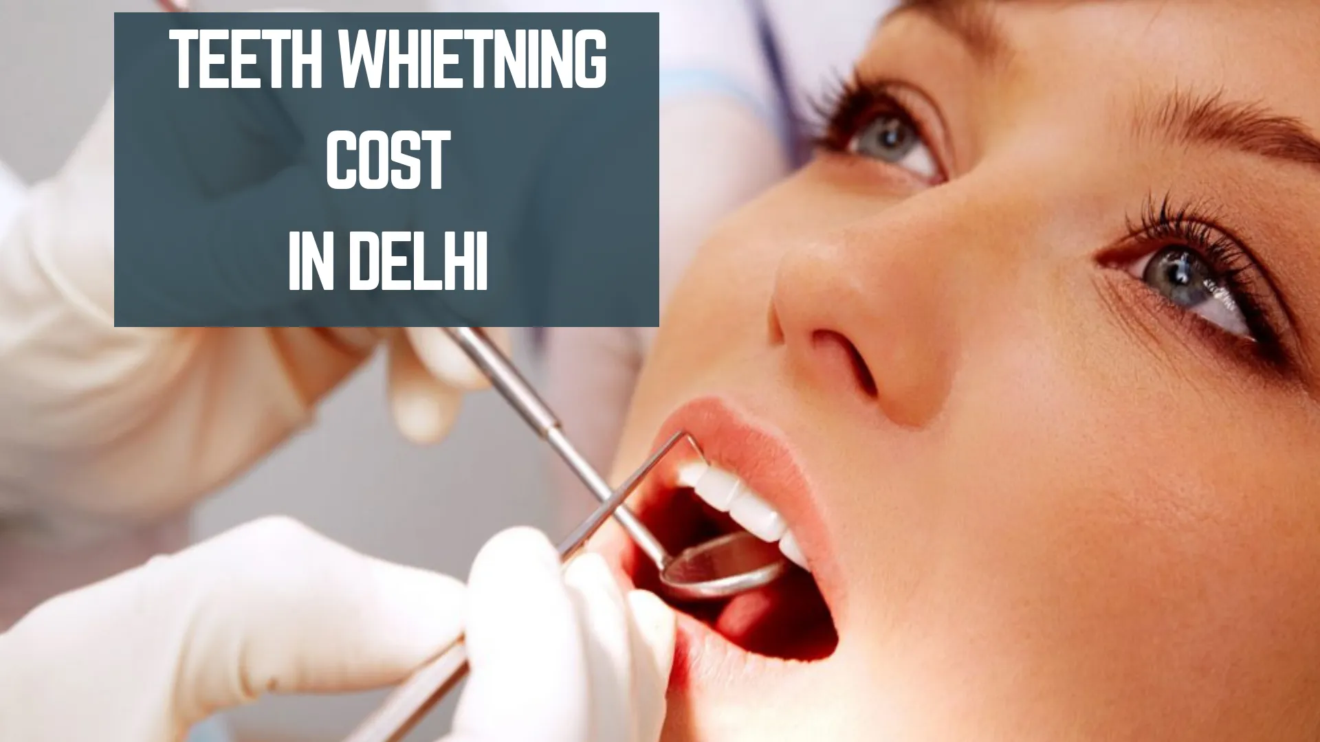 34441 in office teeth whitening