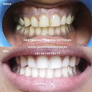 34441 teeth whitening aftercare