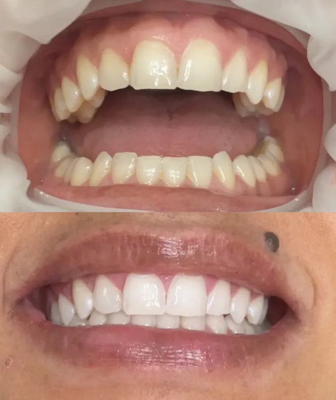 34444 in office teeth whitening