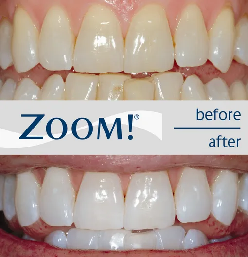 34444 teeth whitening before after