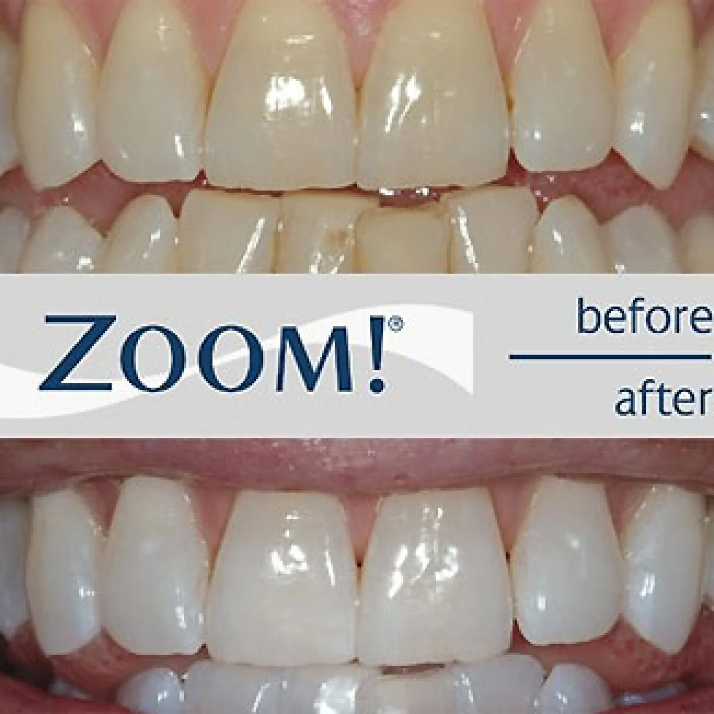 34453 zoom teeth whitening denver smile