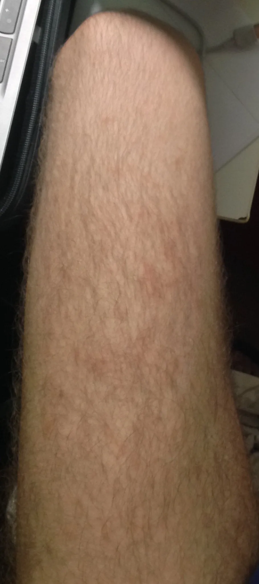 34464 sun exposure