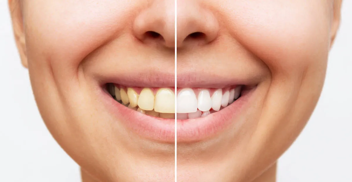 34471 professional teeth whitening