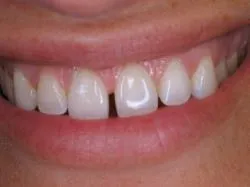 34471 sensitive teeth whitening