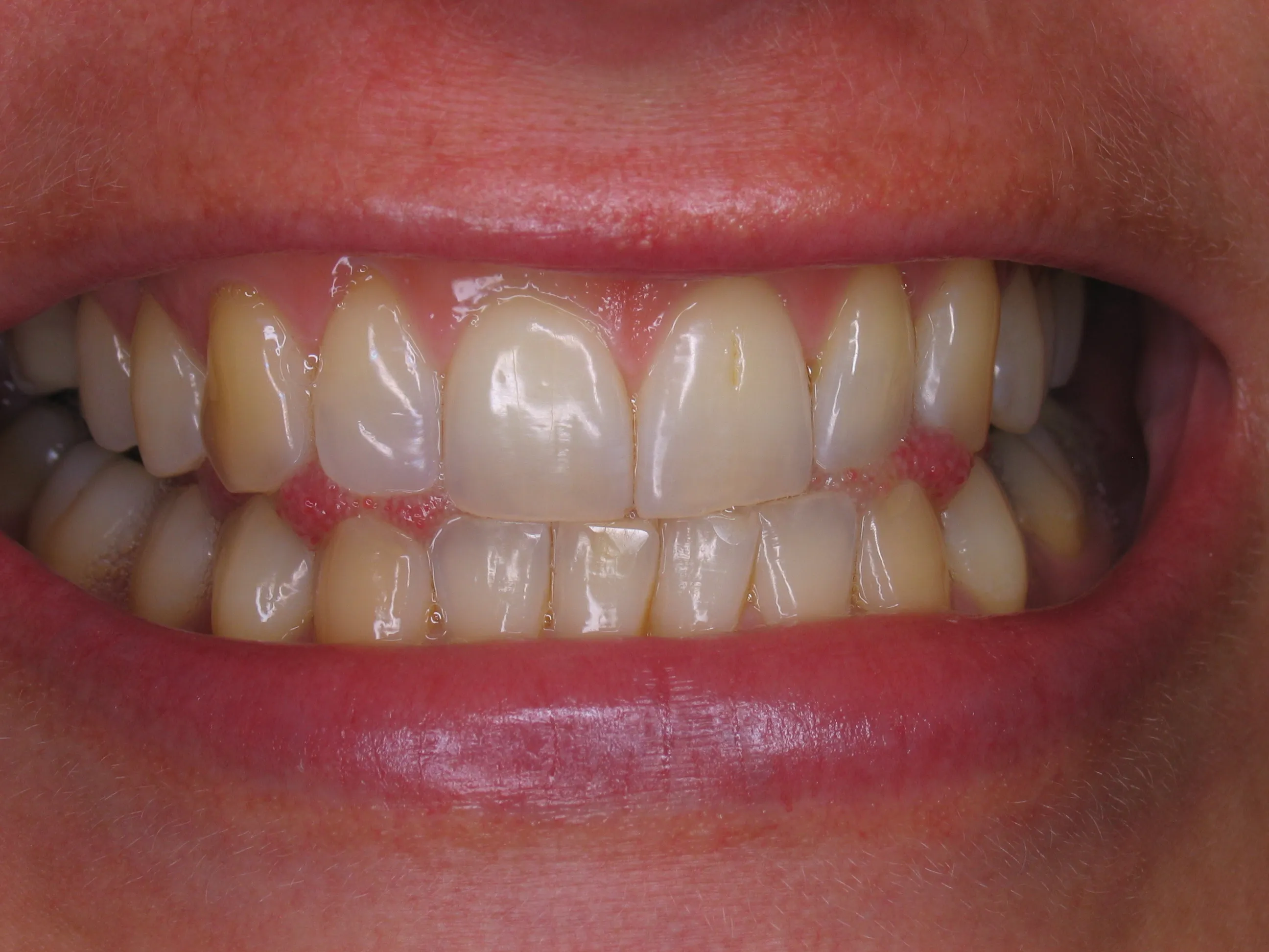 34471 teeth whitening thin enamel risks