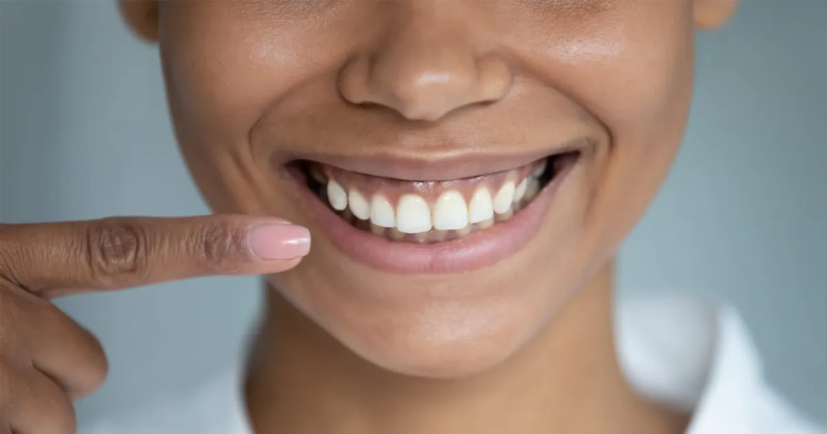 34474 professional teeth whitening