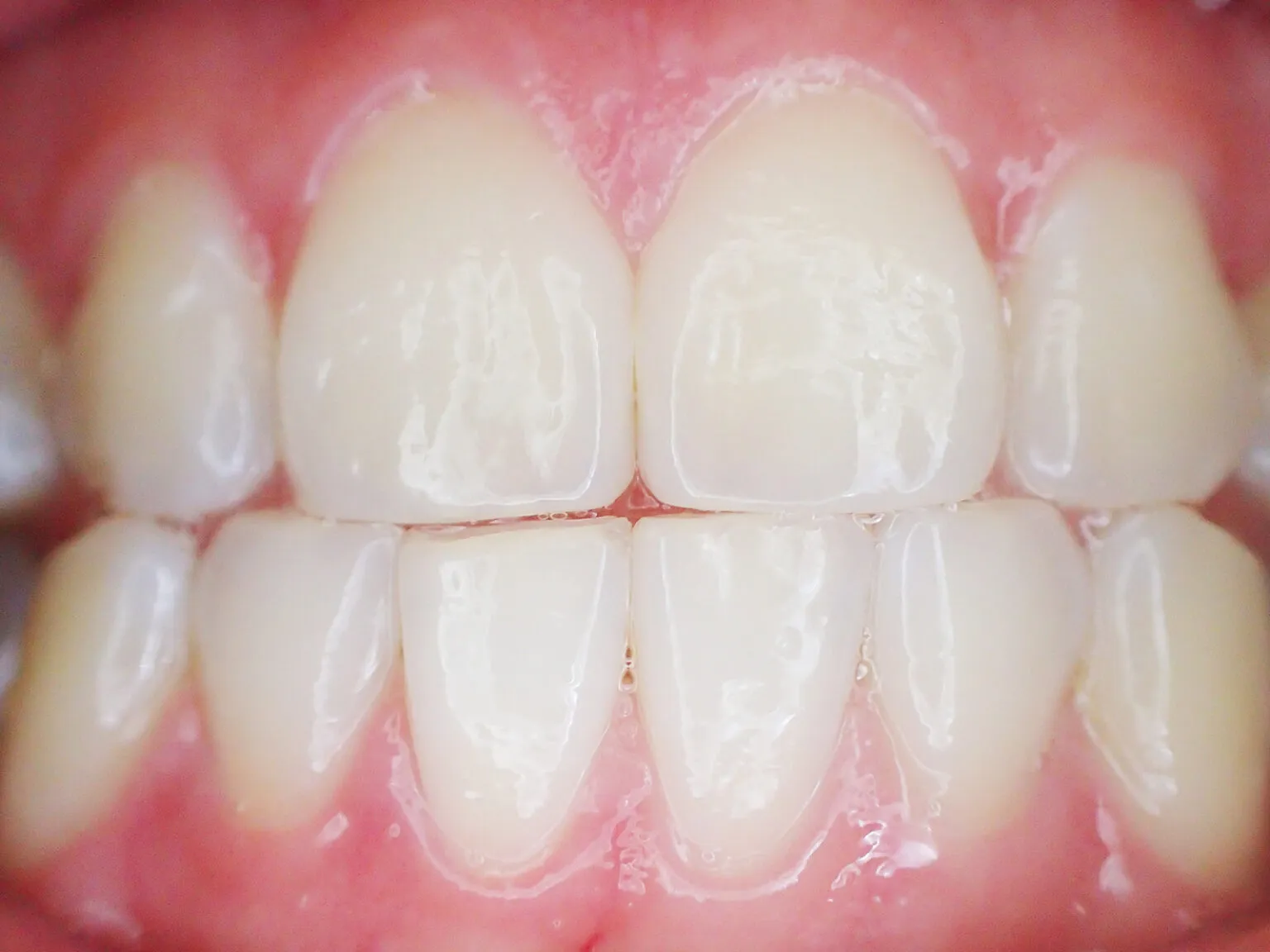 34474 teeth whitening sensitivity