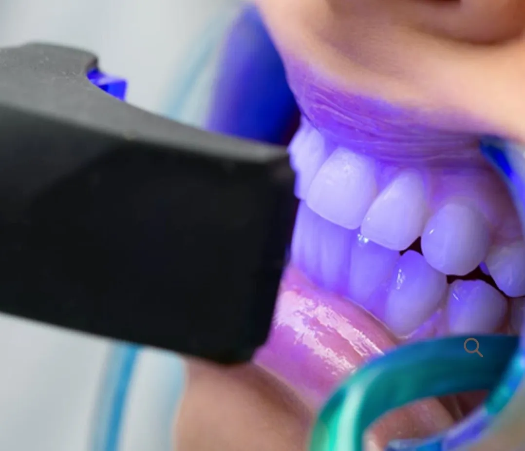 34490 teeth whitening nottingham overview