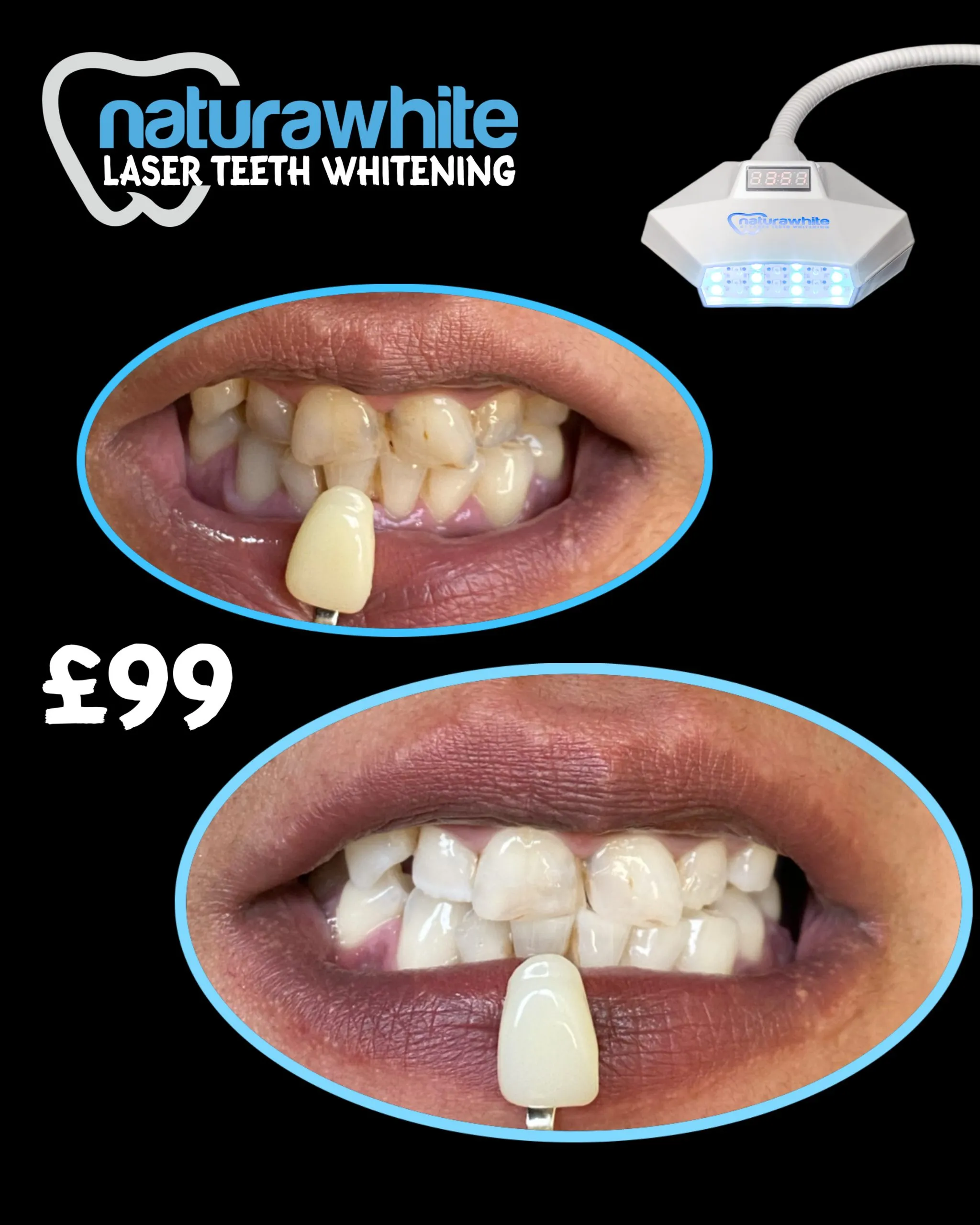 34490 teeth whitening results