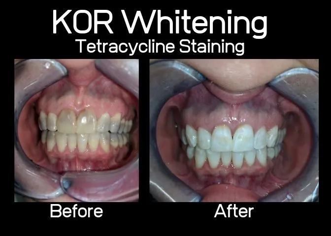 /img/34503-kor-whitening-dentist.webp