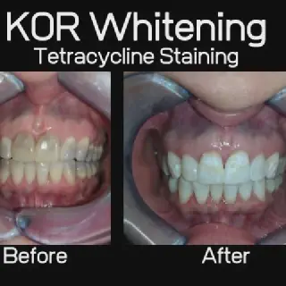 /img/34503-kor-whitening-dentist.webp