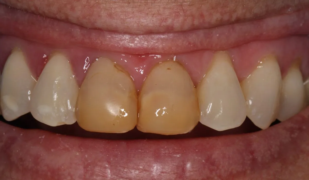 34503 kor whitening patient 1